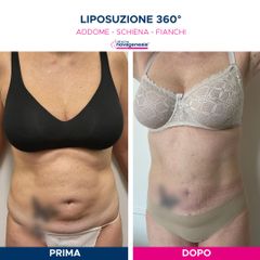 Liposuzione  - Cliniche Novagenesis - dott. Alberto Rossi Todde