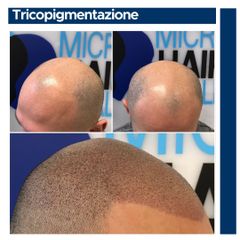 Tricopigmentazione - Cliniche Novagenesis - dott. Alberto Rossi Todde