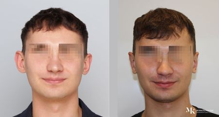 Korekcja uszu - Dr Maciej Kulicki - Klinika Dr Szczyt