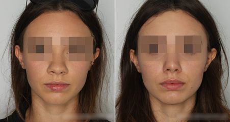 Korekta nosa - Dr Maciej Kulicki - Klinika Dr Szczyt