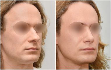 Korekta nosa - Dr Michał Charytonowicz