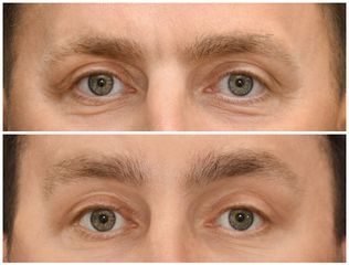 Blefaroplastyka - Dr Michał Charytonowicz