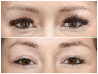 Blefaroplastyka - Dr Michał Charytonowicz