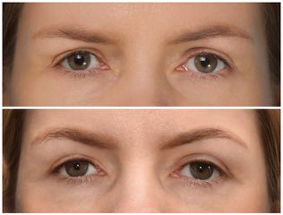 Blefaroplastyka - Dr Michał Charytonowicz