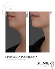 liposukcja podbródka Dr Wiktor Pascal