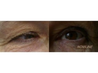Blefaroplastyka  - przed i po