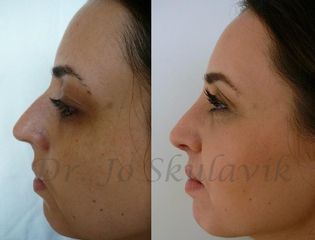 septorhinoplasty5