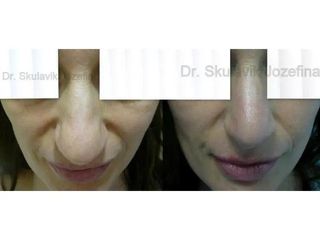 Operácia nosa (Rhinoplastika)