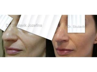 Operácia nosa (Rhinoplastika)