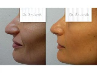 Operácia nosa (Rhinoplastika)