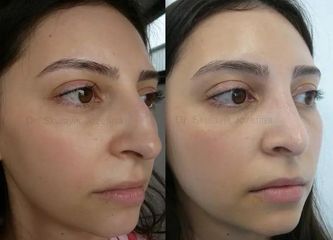 Operácia nosa (Rhinoplastika)