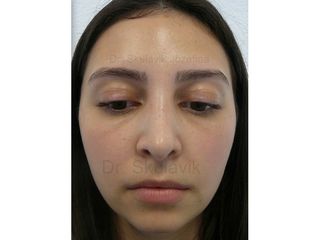 Operácia nosa (Rhinoplastika) - Dr. med. Jozefina Skulavik