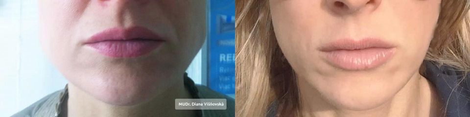 Aplikácia botulotoxínu - zúženie sánky
