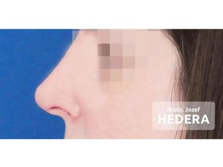 Operácia nosa (Rhinoplastika) - Concept Clinic