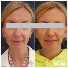 mudr. jozef hedera_facelift_concept clinic2