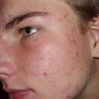 Akne - Hautproblem nicht nur der jungen Haut