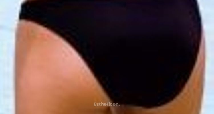 Body Contouring. Was ist das?