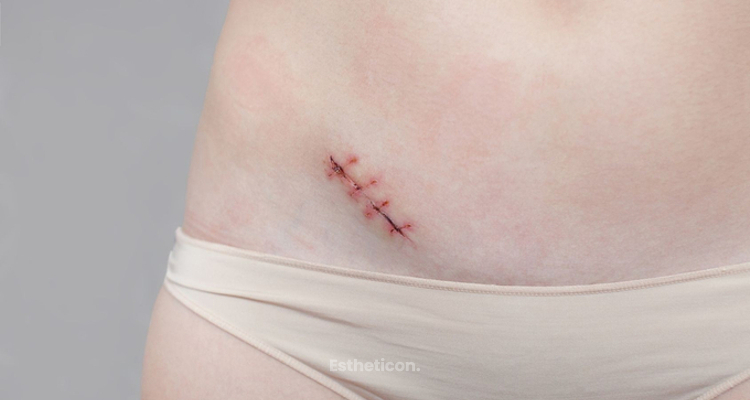Die optimale Narbenpflege nach einer ästhetischen Operation