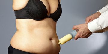 Injektionslipolyse-Realistischer Einsatz Injektionslipolyse-Realistischer Einsatz