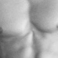 Operation der vergrößerten männlichen Brust: Gynäkomastie