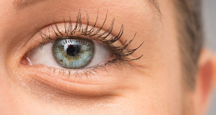Wirksam Augenringe entfernen - Blepharoplastik, Laser oder Hyaluronsäure?