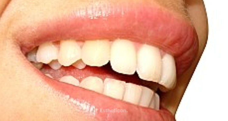Zahnfleischkorrektur - Teil 4 unserer Zahnmedizinserie