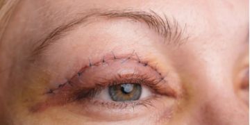 Welche Komplikationen können bei einer Augenlidstraffung auftreten?