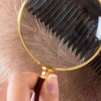 Wie verläuft die Heilung nach einer Haartransplantation?