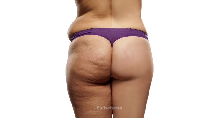 Cellulite dauerhaft bekämpfen mit Emtone