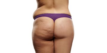 Cellulite dauerhaft bekämpfen mit Emtone Cellulite dauerhaft bekämpfen mit Emtone