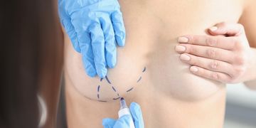 Brustverkleinerung - Ein Experteninterview mit Dr. Maria Wiedner Brustverkleinerung - Ein Experteninterview mit Dr. Maria Wiedner
