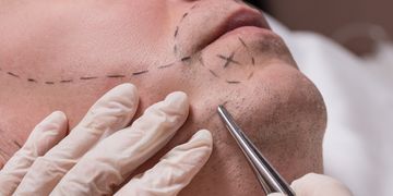 Was sollte man über die Barttransplantation wissen und wie wird sie durchgeführt?