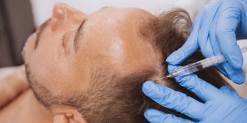 PRP Haarwurzelbehandlung: Was es ist und wie es wirkt