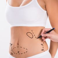 Liposuktion: Alles was Sie über die Heilung wissen sollten