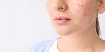Akne und Hautunreinheiten, ein Dauerbrenner