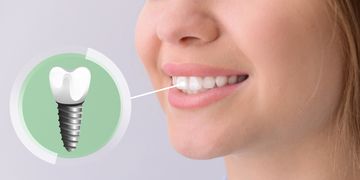Mit Zahnimplantaten gewinnst du dein strahlendes Lächeln zurück