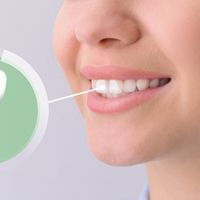 Mit Zahnimplantaten gewinnst du dein strahlendes Lächeln zurück