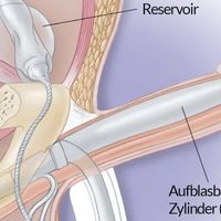 Potenzstörung (erektile Dysfunktion)