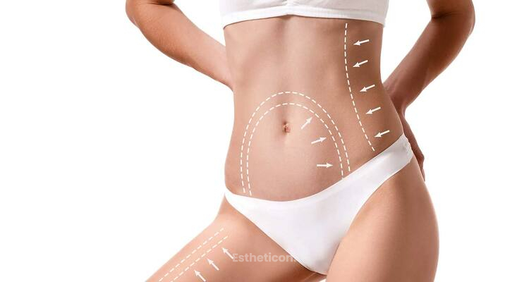 Körperformung mit Fettabsaugung und Eigenfetttransplantation