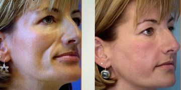 Fat Grafting- Eigenfett-Transfer, Renaissance einer bewährten Methode, insbesondere nach Ozempic Fat Grafting- Eigenfett-Transfer, Renaissance einer bewährten Methode, insbesondere nach Ozempic