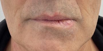 Lippenasymmetrie und deren Korrektur, auch bei Knoten und Verletzungen