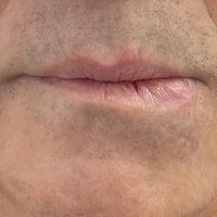 Lippenasymmetrie und deren Korrektur, auch bei Knoten und Verletzungen