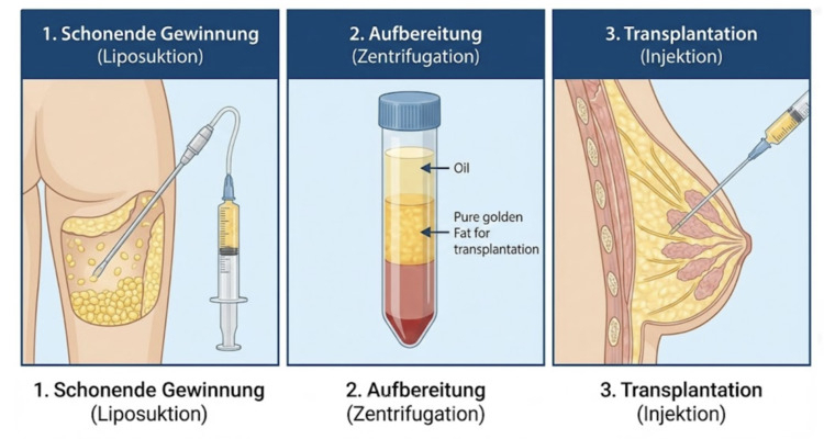 Eigenfetttransplantation (Lipofilling) – verständlich erklärt