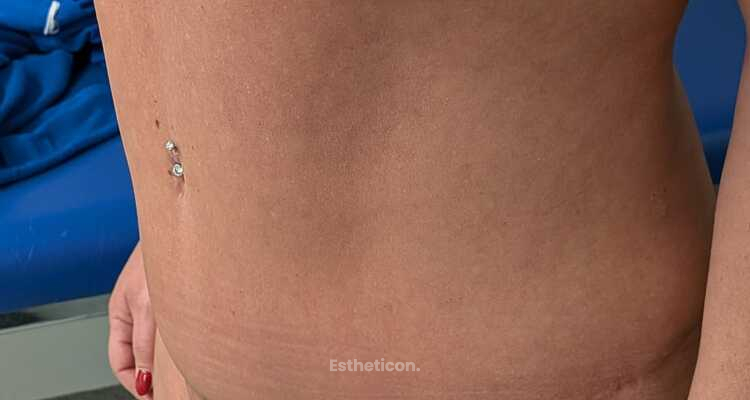 Bauchdeckenstraffung, Fettabsaugung und Venushügellifting: Welche Behandlung ist wann sinnvoll?