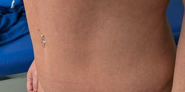 Bauchdeckenstraffung, Fettabsaugung und Venushügellifting: Welche Behandlung ist wann sinnvoll?