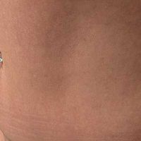 Bauchdeckenstraffung, Fettabsaugung und Venushügellifting: Welche Behandlung ist wann sinnvoll?