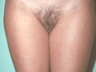 Ultraschall Fettabsaugung resultate - 777515