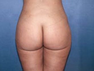 Ultraschall Fettabsaugung resultate - 777516