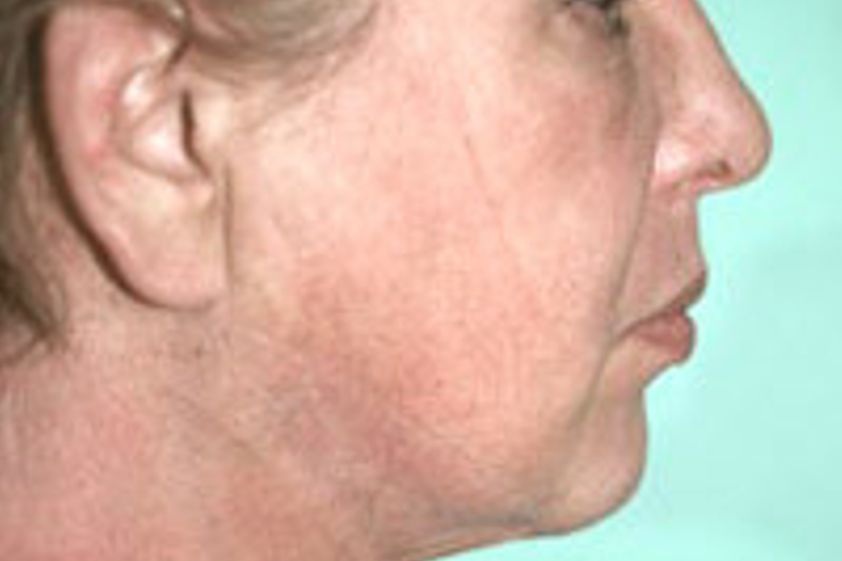 Ultraschall Fettabsaugung resultate - 777517