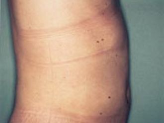 Ultraschall Fettabsaugung resultate - 777518